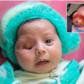 Pakistan reports first documented 285-gram congenital eye tumor in newborn